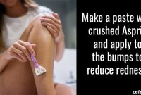 Treat Razor Bumps: Quick Treatments and Preventive Tips